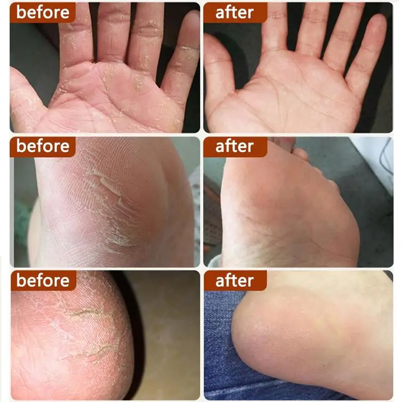 Змеиное масло лошадиная мазь крем для рук и ног уход за кожей антибактериальный