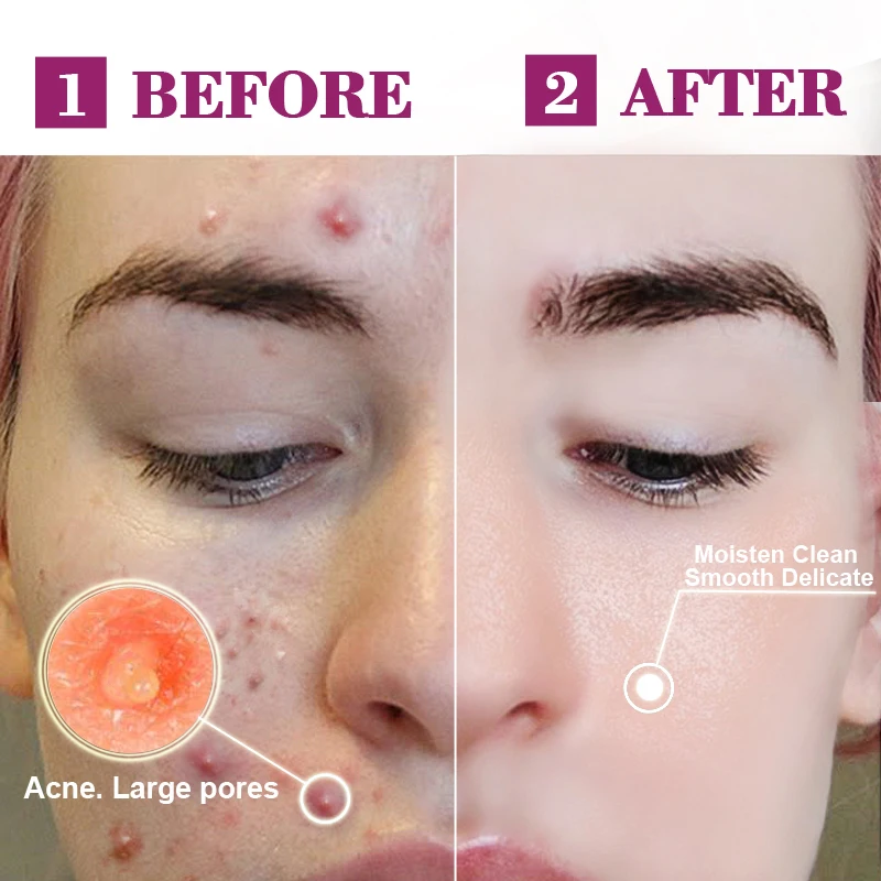 Ртопр прополис ремонт акне осветляющая сыворотка шрам пятна очищающая сужение