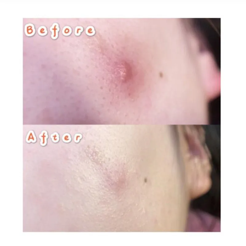 LANBENA маска от акне прыщи патч 28 шт. невидимые наклейки лечение прыщей средство для