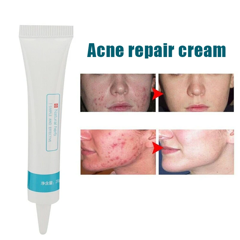 Новейший 20 г Крем для удаления шрамов увлажняющий крем мазь восстановления