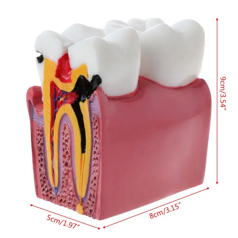 

6 Times Dental Caries Comparation Anatomy Teeth Model for Dental Anatomy Lab Teaching Studying Researching Tool