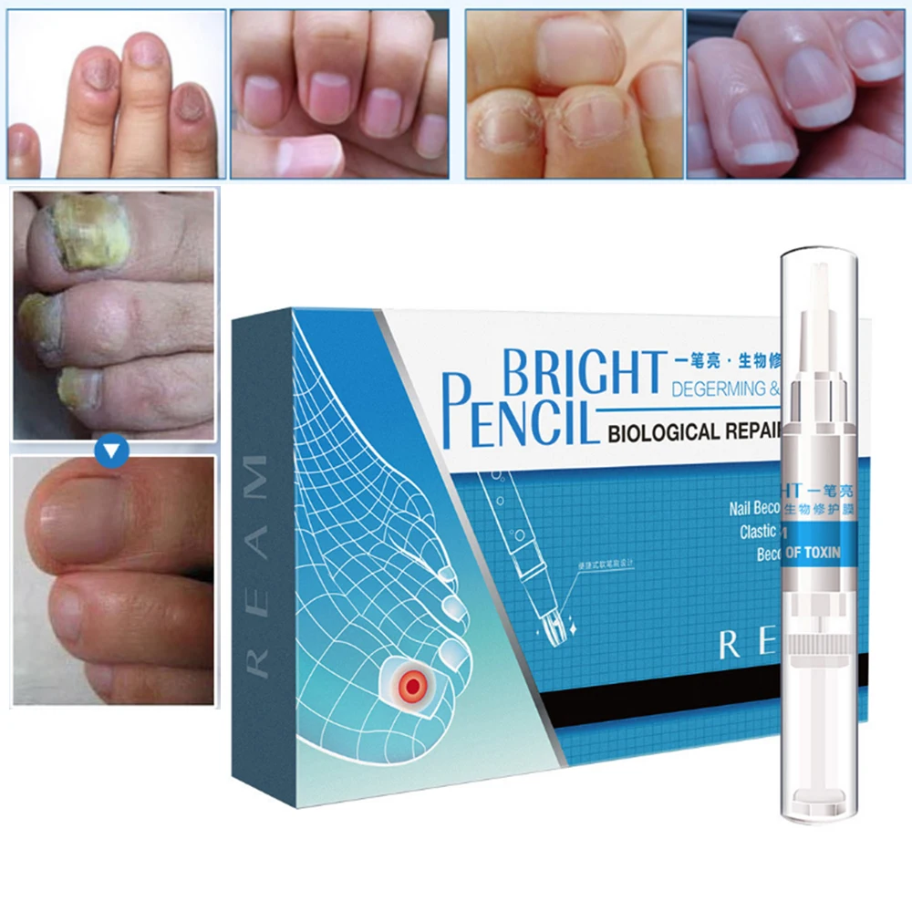 3 мл китайская медицина травы Лечение грибка ног ногтя против грибкового