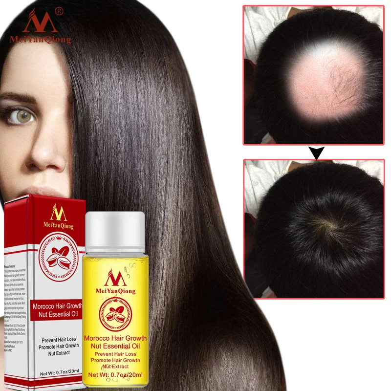 

Fast Hair Growth Essence Hair Loss Product Essential Oil Treatment Preventing Hair Loss Baldness Scalp Hair Care Products 20ml