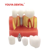 dental model resin 4times tooth implant model for studying teaching module medical science oral dentist dentistry products red