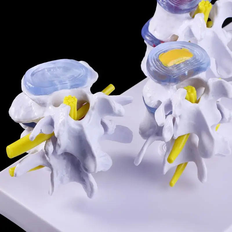 

1 Set Human Lumbar Lesion Spine Statue Display Model Teaching Learning Tool