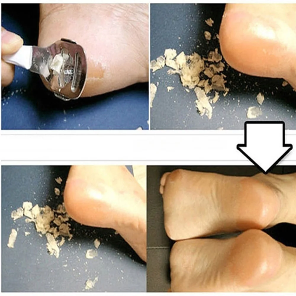Инструмент для ухода за ногами инструмент удаления омертвевшей кожи мозоль