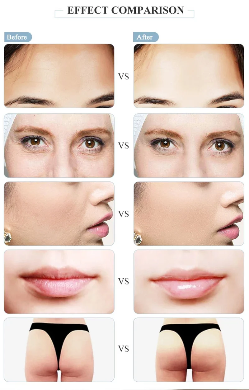 0,5 мл 0,3 мл гиалуроновая ручка распылитель гиалуроновой кислоты ручка для инъекций губ пистолет для удаления морщин лифтинг губа наполнитель инжектор гиалурон