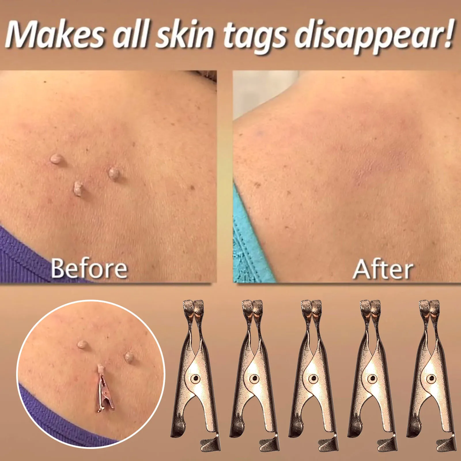Маленькие клипсы для удаления бородавок с кожи Машинка магнитных бирок средство