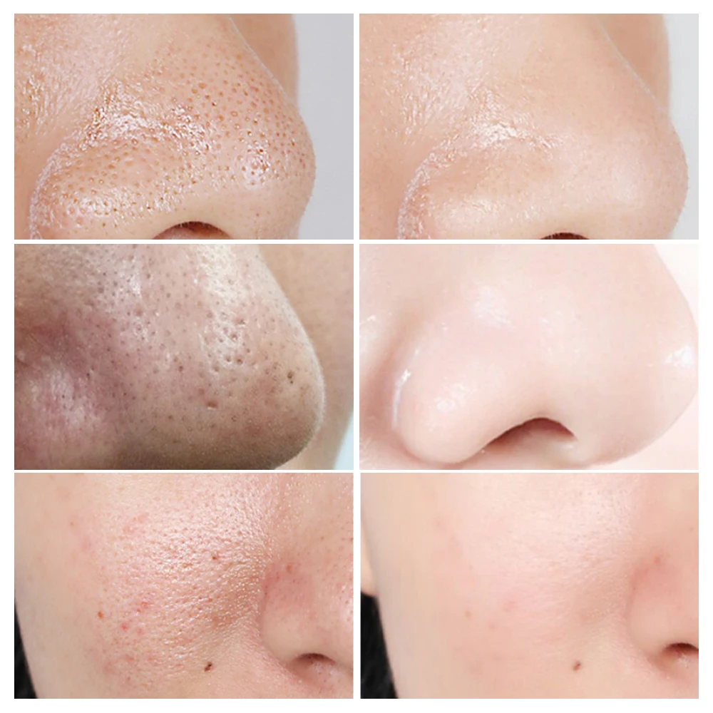 

Green Tea Blackhead Remover Serum Black Head Removal Facial Beauty Shrink Pores Treatment Shrinks Pore Essence Face Skin Care