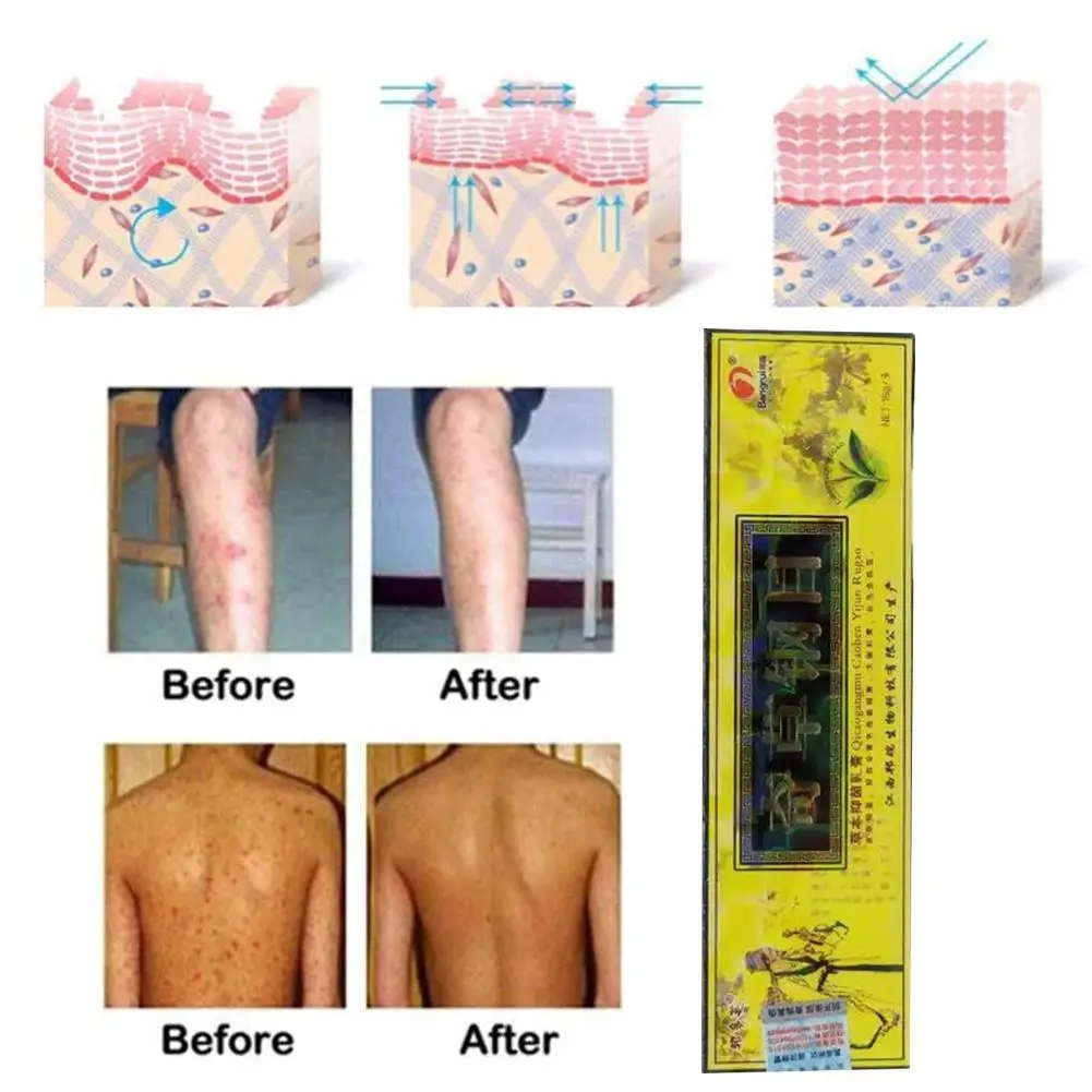 

Psoriasis Cream Dermatitis Eczematoid Eczema Ointment Traditions Care Cream Skin Chinese Skin Psoriasis Cream Herbal Treatm G2P7