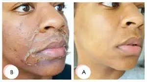 2ML 70% TCA Skin Peel Kit Removes Tags Age Spots White Stretch Marks Free Shipping | Красота и здоровье