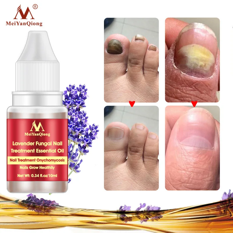 

10ml Nail Fungus Treatment Anti Fungal Toenail Repair Care Lavender Essential Oil SANA889