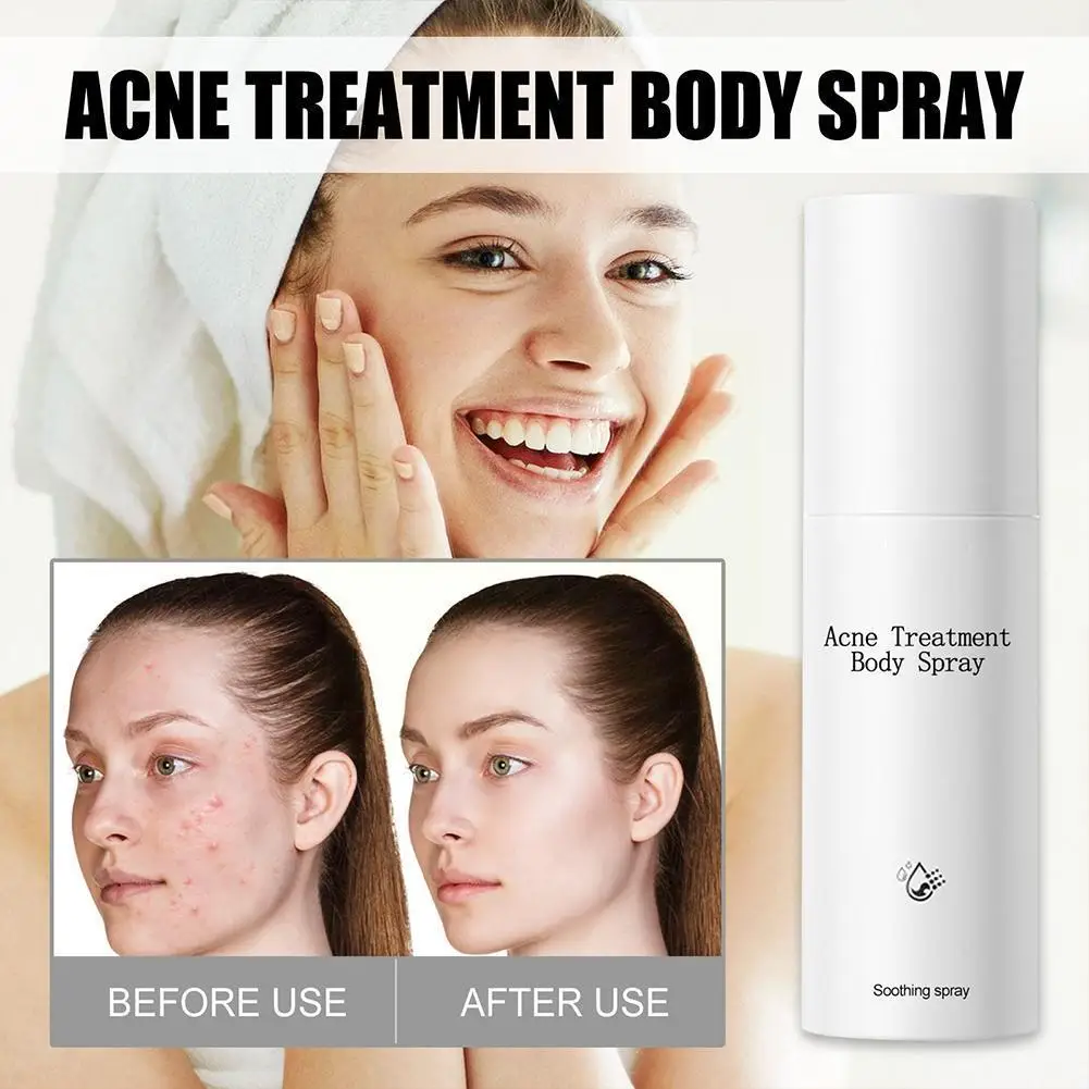 100ml New Acne Treatment Spray Moisturizing Spray Skin Face Treatment Essence Oil-control Spray Oil Acne N7f1