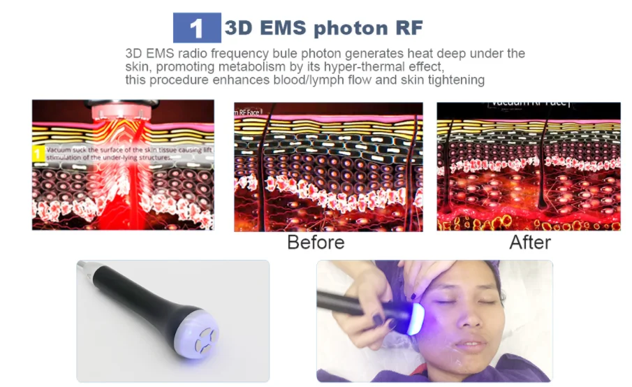 4D ультразвуковая кавитация EMS RF электропорация косметический инструмент для похудения