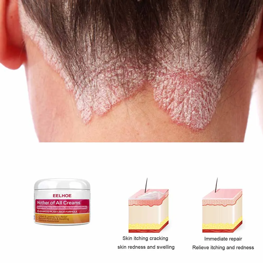 

Dermatitis Eczema Ointment Treatment Psoriasis Cream Face Care Of Skin Redness And Rash For Itchy Sensitive Skin