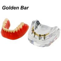 dental teeth model overdenture restoration 4 precision implants 6008 silver bar