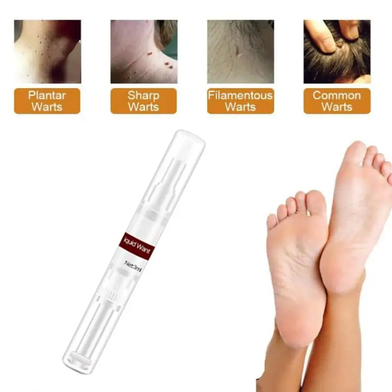 2 шт. жидкость для удаления бородавок и 3 мл | Красота здоровье