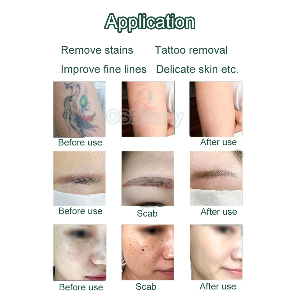 Горячая Распродажа неодимовый Лазерный Аппарат Q 1064 нм и 532 для удаления