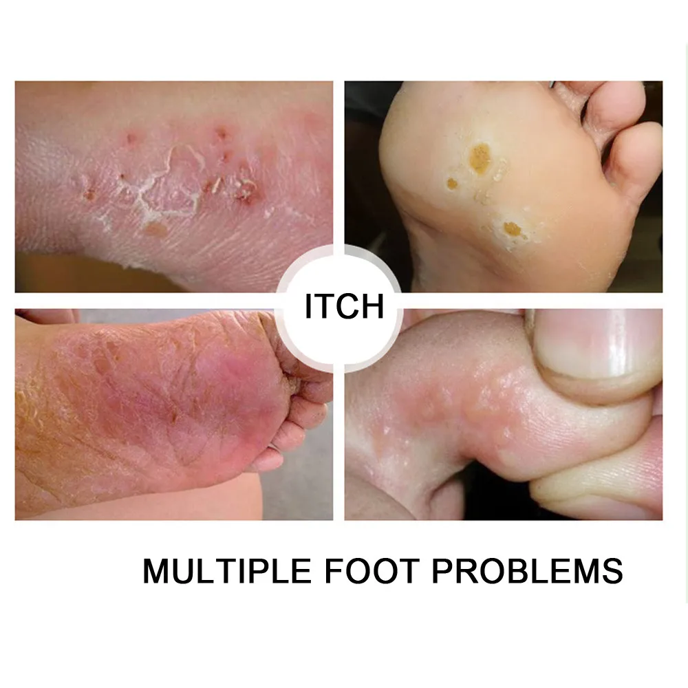 Маска для ног яркость осветление пилинг плохой запах обувь против мозолей носки