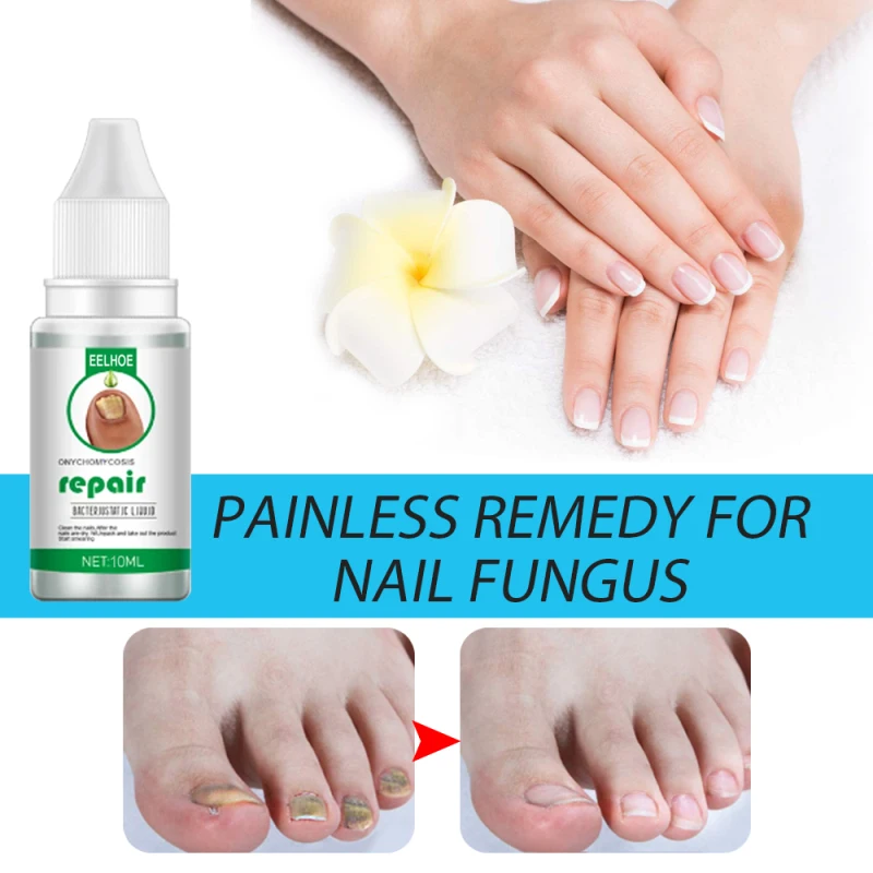 

10/20/30ML Fungal Nail Repair Serum Care Foot Nail Fungus Removal Gel Anti Paronychia Onychomycosis For People Foot Care TSLM1