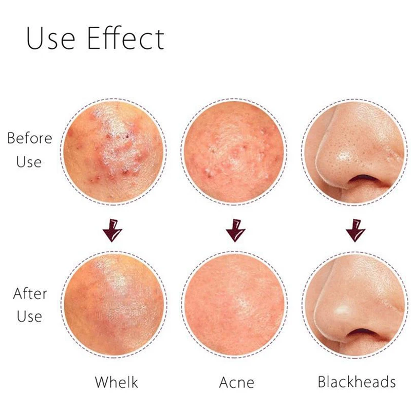 AuQuest уход за кожей лица удаляет мертвую кожу пилинг гель экстрактор для прыщей