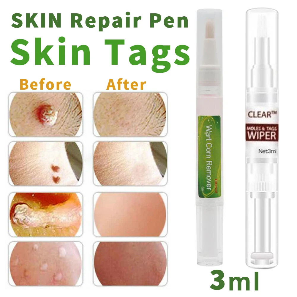 Новинка 3 мл лечение половых органов удаление папилломы бородавок жидкость с