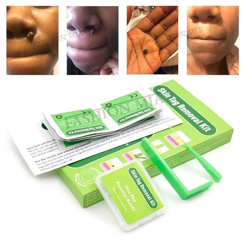

Microband Skin Mole Tag Removal Kit Skin Tag Remover Skin Mole Wart Remover Skin Tag Removal Kit with Cleansing Pads Face Care