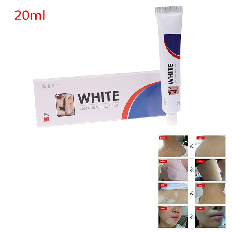 1 шт. лечебный пигмент для лечения белых пятен | Красота и здоровье