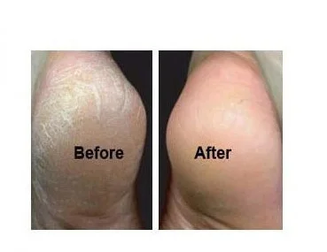 Нержавеющая сталь щетка для стоп ороговевшей кожи средство удаления костных