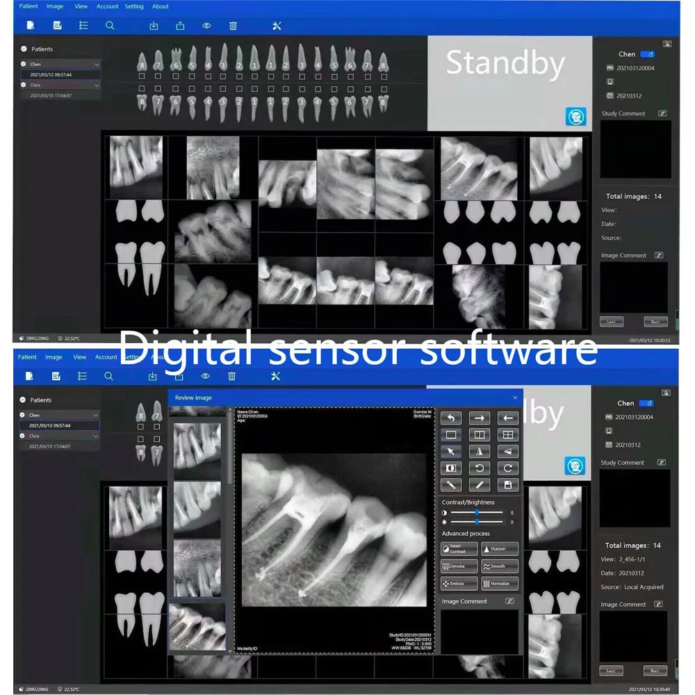 Стоматологическая цифровая Интраоральная рентгенографическая система