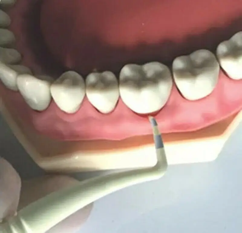 Стоматологический инструмент для диагностики имплантации на глубине зубов