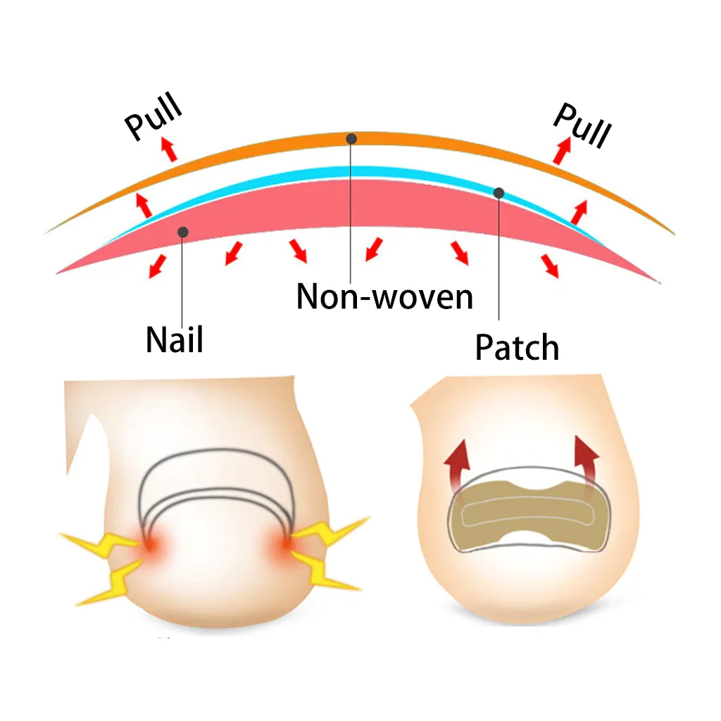 

1PC Professional Effectiv Treatment Ingrown Toenail Correction Pedicure Tools Paronychia Foot Care Nail Recover Tools