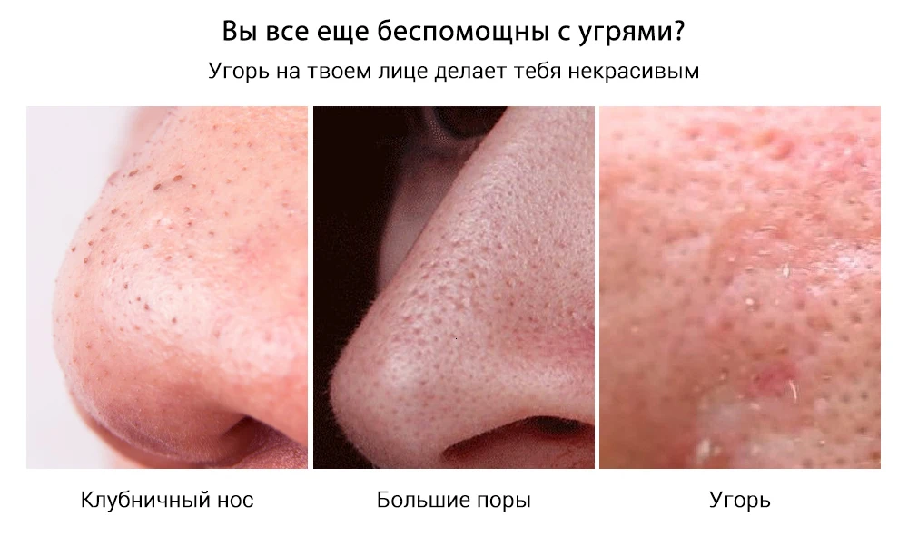 LANBENA, маска для удаления черных точек, для лица, полоска пор, черная маска для пилинга носа, лечение акне, унисекс, глубокое очищение кожи, уход за кожей, красота