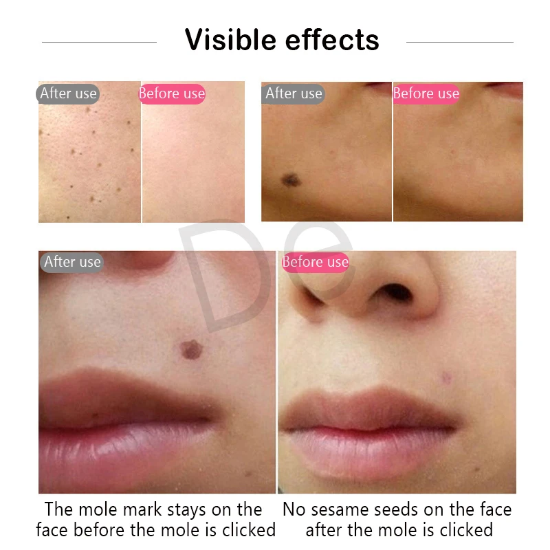 Fibroblast плазменная ручка для лица лифтинга век морщин удаления пятен лазерная