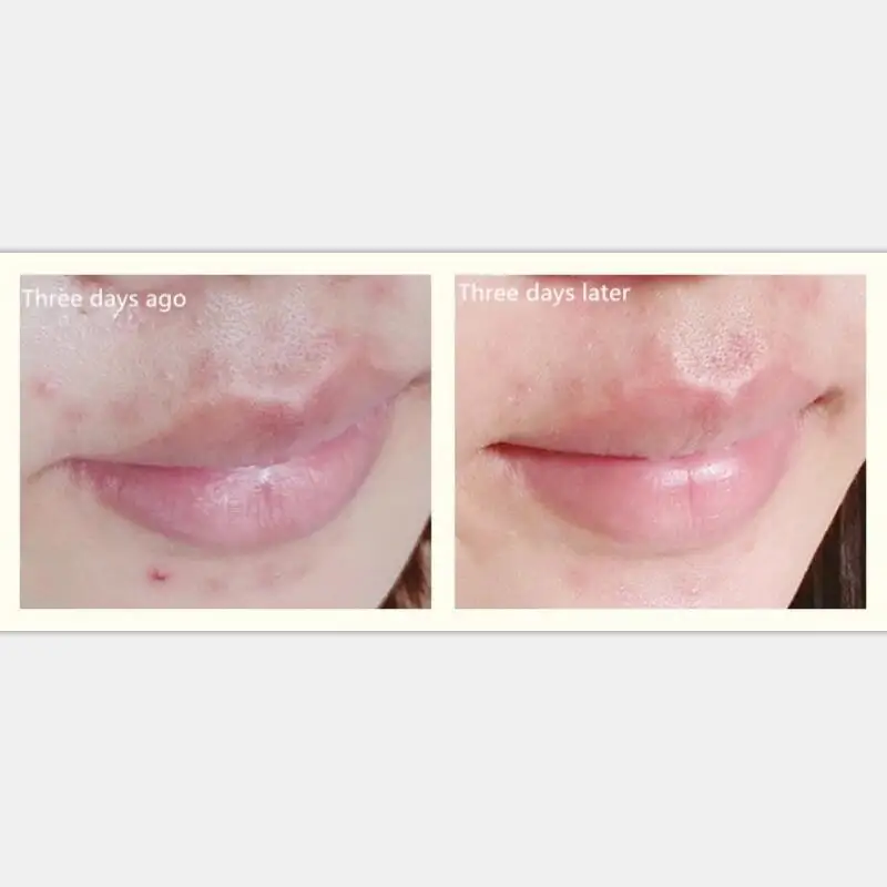 

Night cream acne scar faded acne cream moisturizing men and women 30g