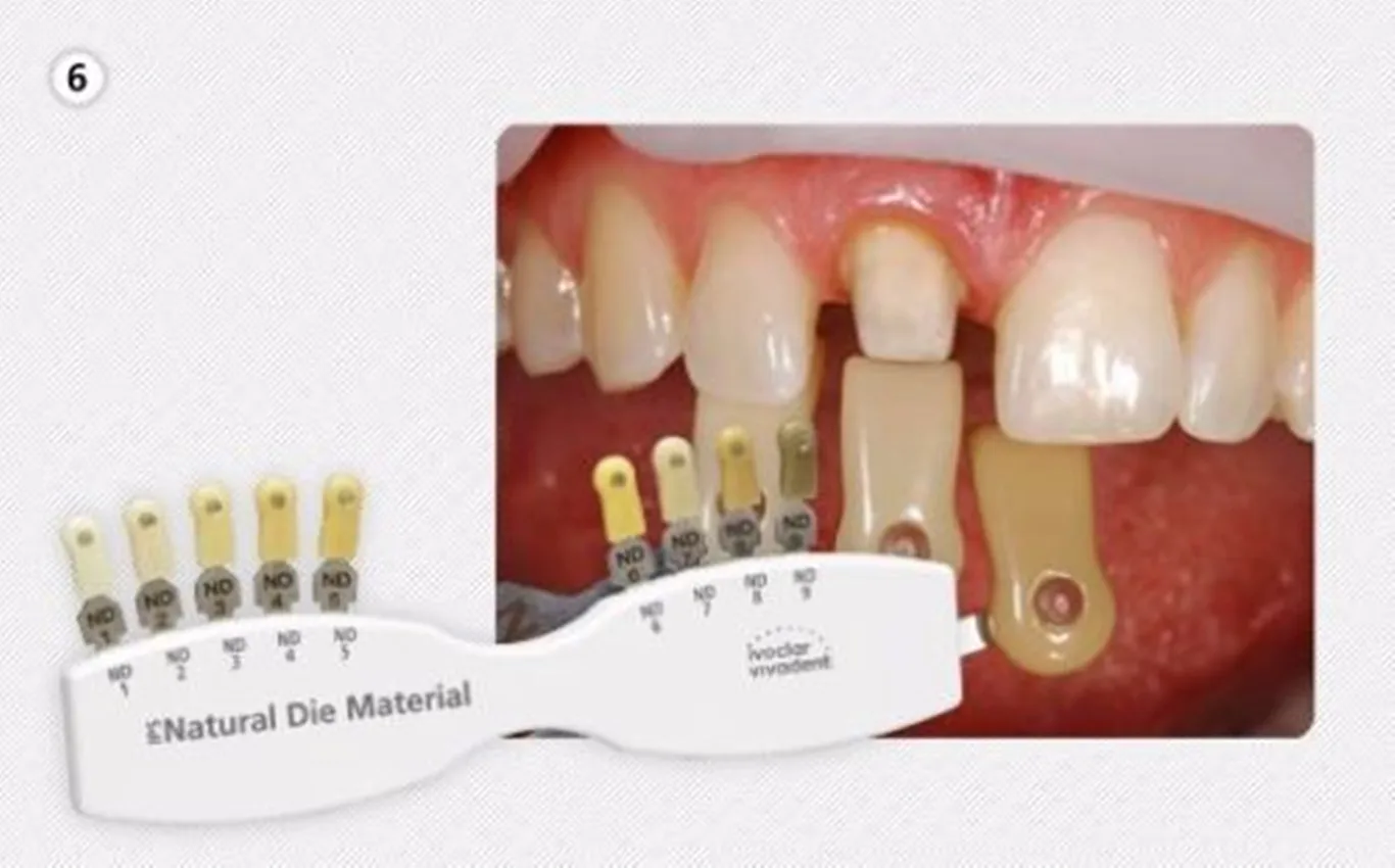 Стоматологический отбеливатель для зубов Классическая направляющая теней IPS