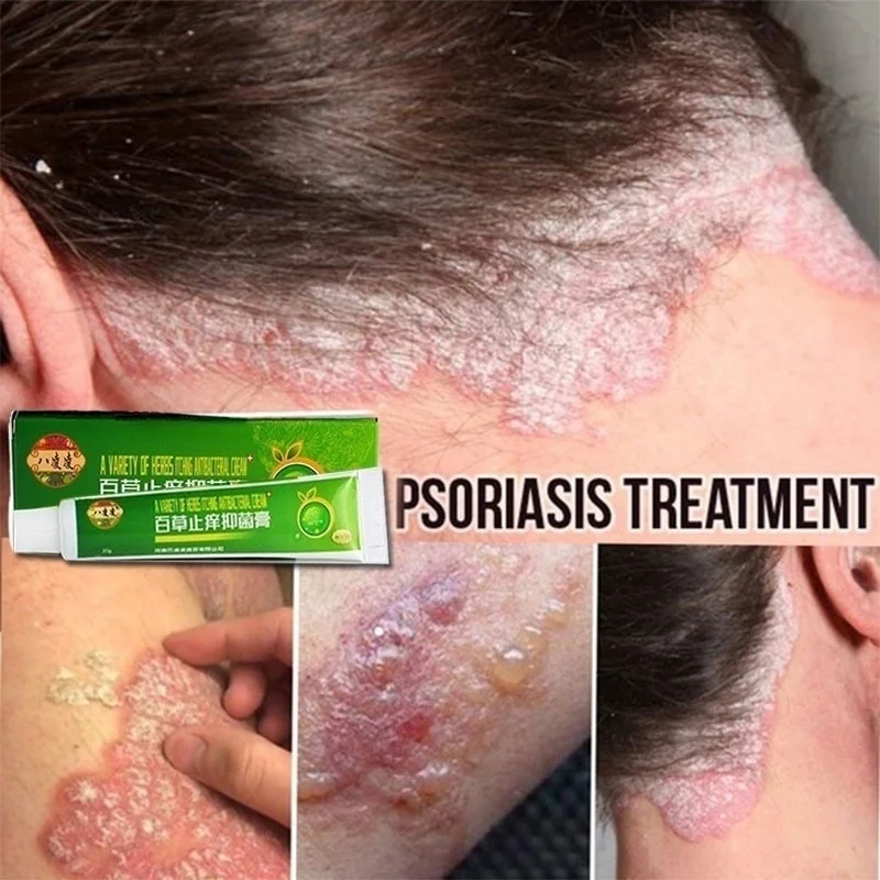 100% оригинальный крем от псориаза Антибактериальный противозудный дерматит