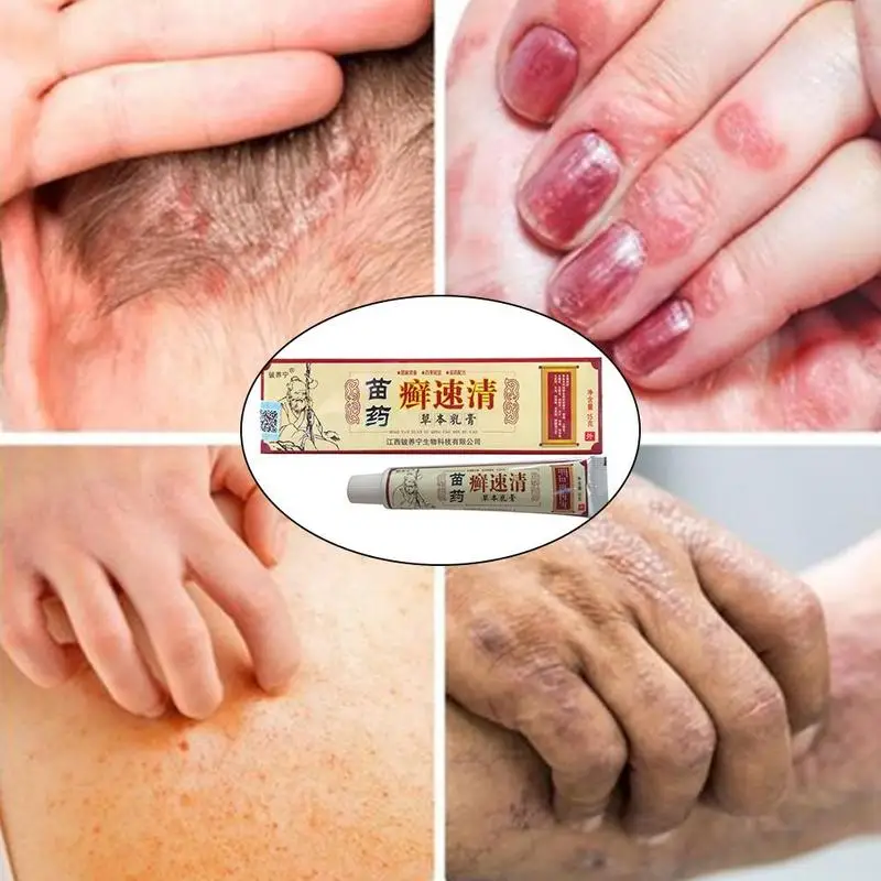 Псориаз дерматит экзема зуд псориаз мазь китайские кремы Очищающий травяной