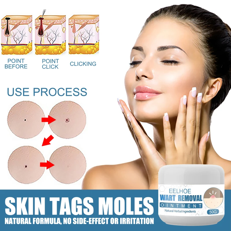 

EELHOE Warts Remover Skin Tag Removal Antibacterial Ointment Flat Warts Plaster Mole Skin Dark Spot Treatment Herbal Cream 50g