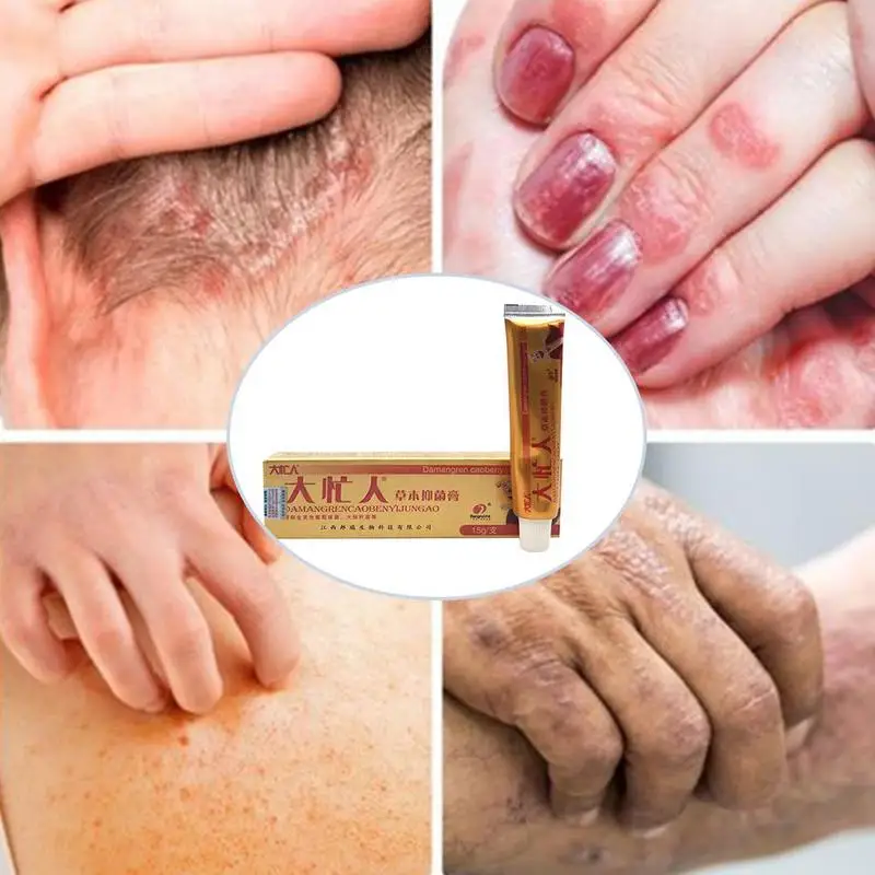 1 шт. оригинальный крем Damangren псориаз дерматит экзема зуд для проблем с кожей