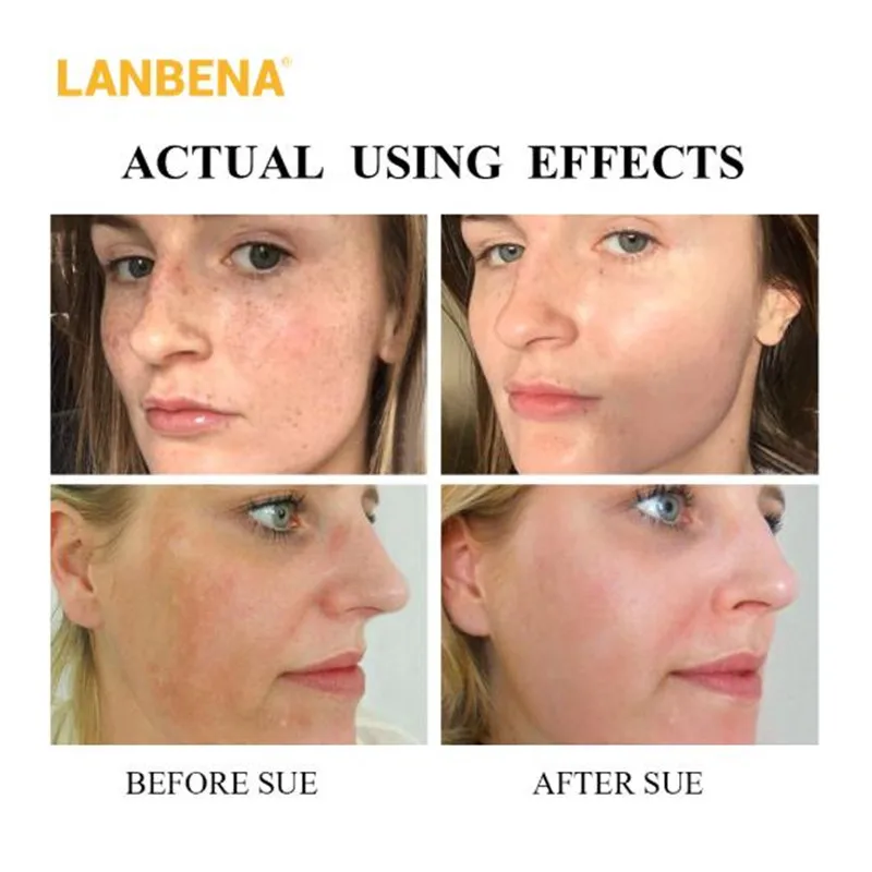 Отбеливающий крем LANBENA для лица против морщин сквалановый питательный