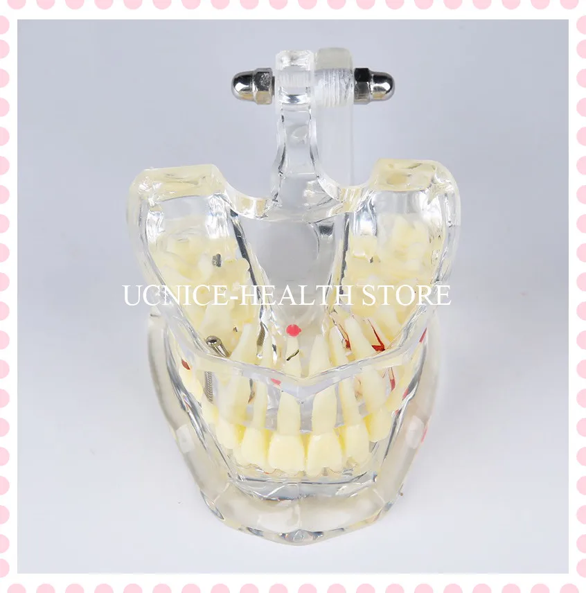 Стоматологическая модель зубов с восстановительным мостом/стоматологическая