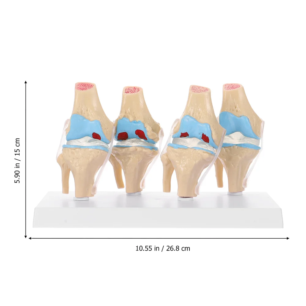 

Human Lesion Knee Joint Anatomy Model Anatomical Human Osteoarthritis Knee Model