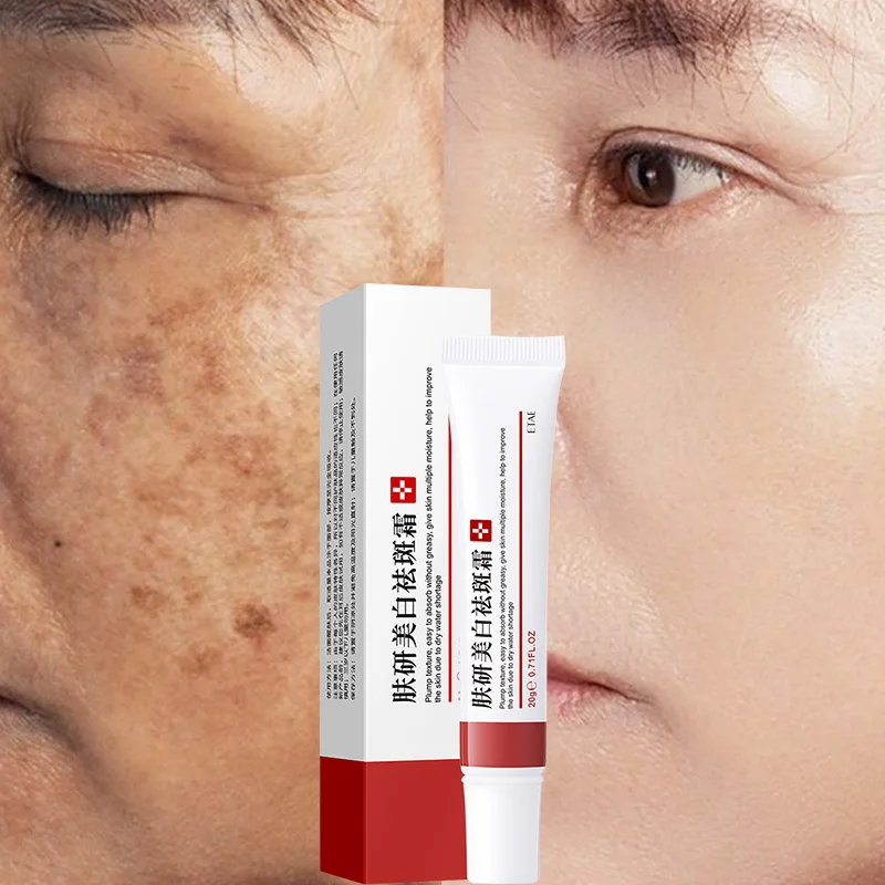 

Whitening Cream Dilute Spots Remove Acne Improve Dark Yellow Skin Freckle Cream Fade Scars Pigmentation Melasma Brighten Skin