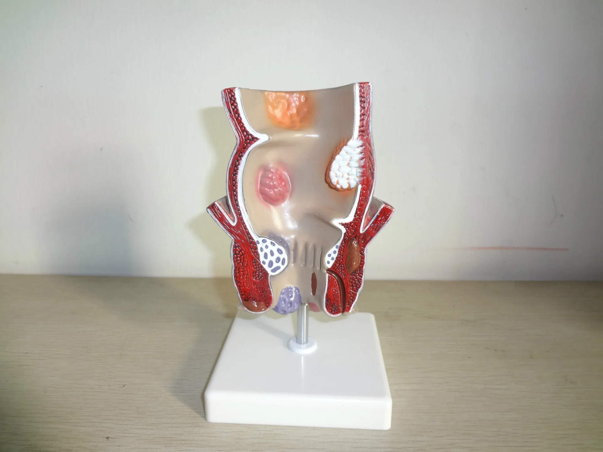 5-кратная анатомия человека модель поражения ректального геморроя внутренняя