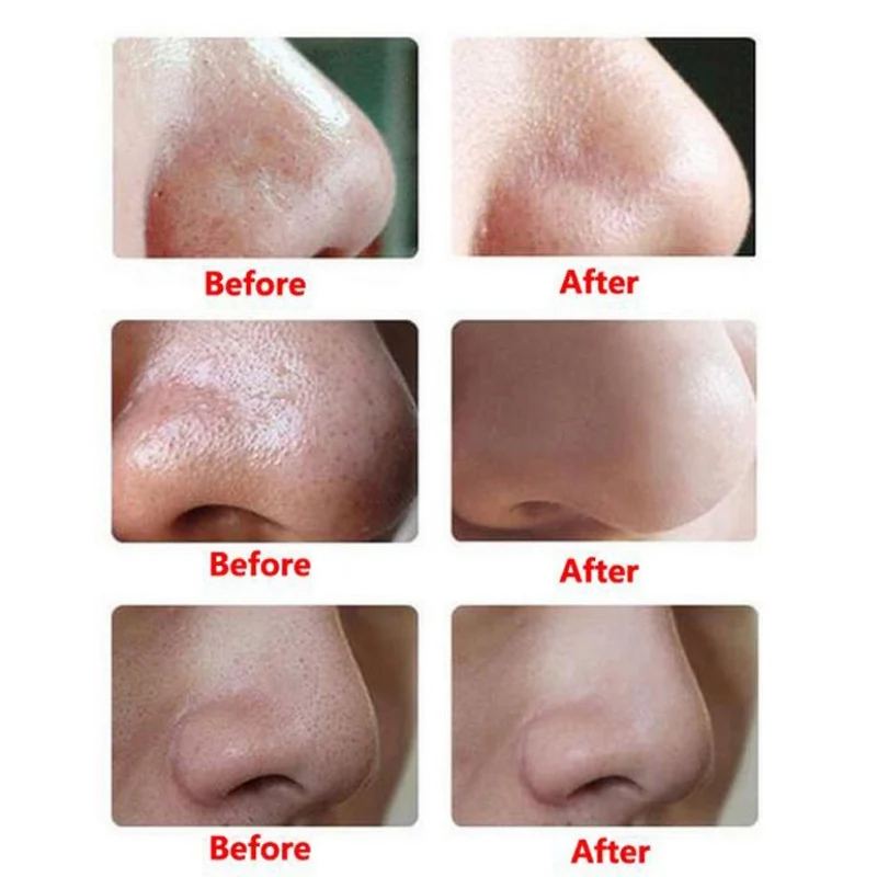 

Electric Facial Cleaner Beauty Instrument Blackhead Remove Acne Cleane Pore Face Deep Cleaning