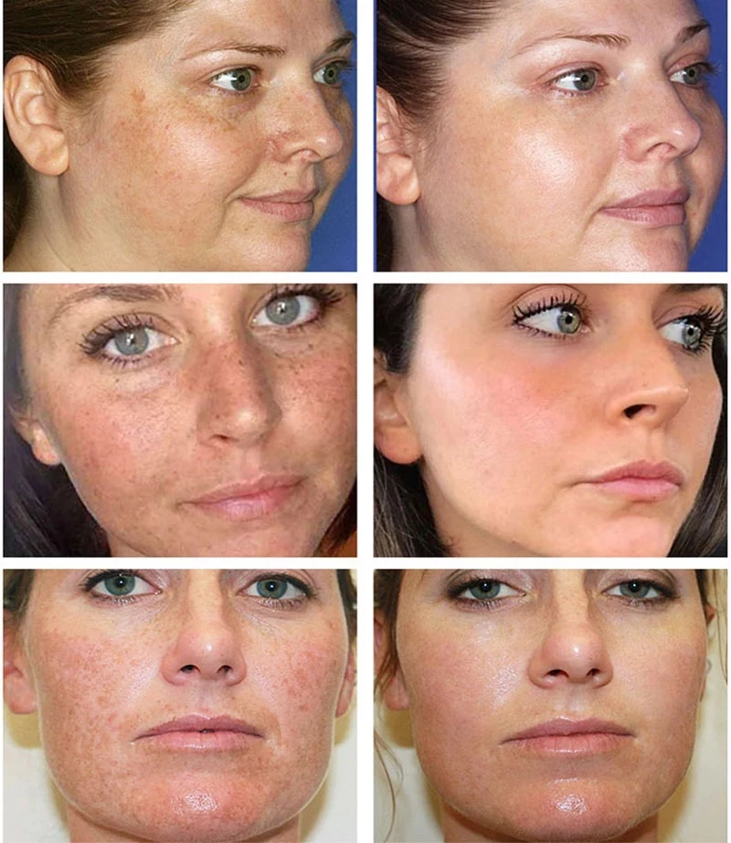 Effective Whitening Freckle Cream Remove Melasma Acne Spot Pigment Melanin Dark Spots Pigmentation Moisturizing Gel Skin Care | Красота и