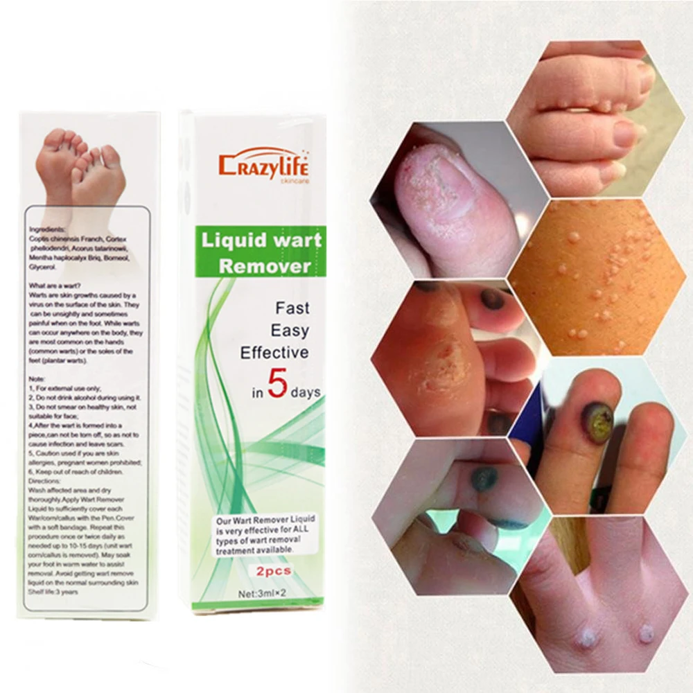 5 дней ручка для удаления кожных тегов натуральный моль здоровья Nevus бородавка