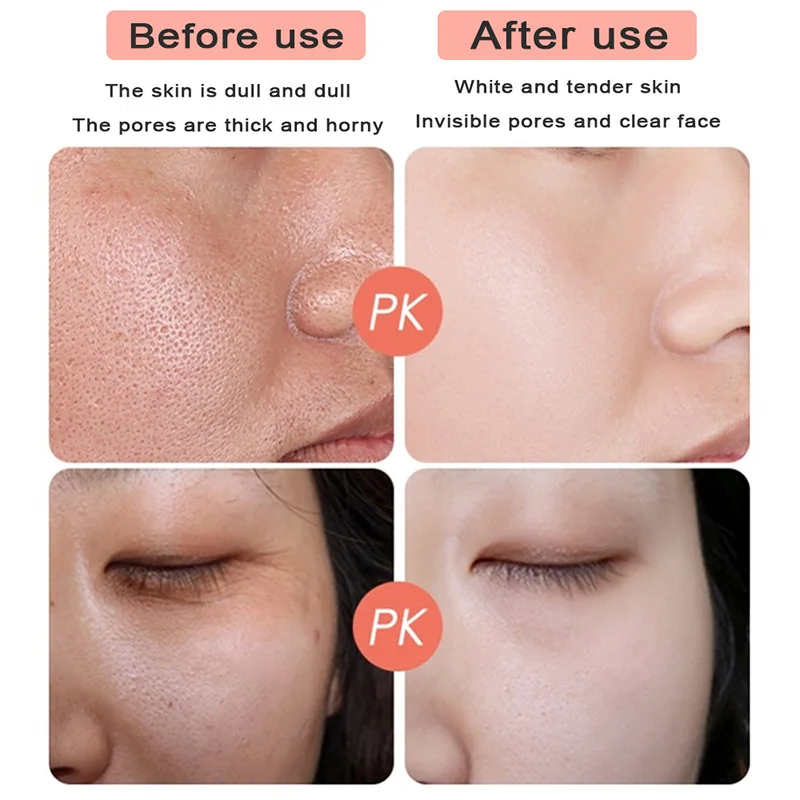 

Anti-Acne Oil Control Cream Shrink Pores Nourishing Whitening Remove Acne Facial Skin Care Facial Care SMJGood