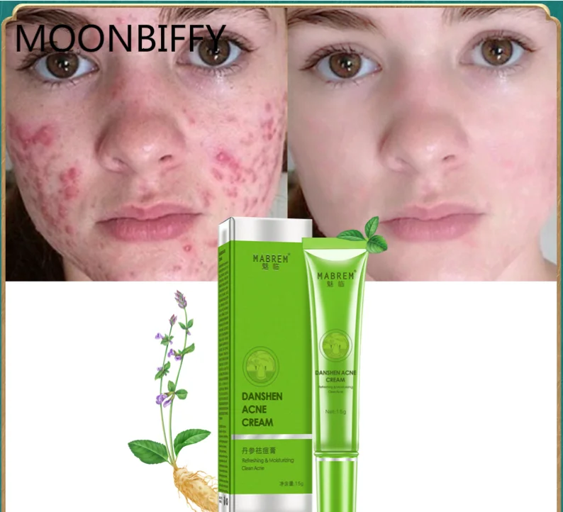 

Acne Treatment Skin Care Remove Acne Oil Control Oil Shrink Pores Whitening and Moisturizing Scar Removal Facial cream